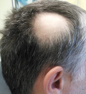 Alopecia areata in male