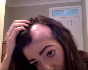 Alopecia in Females